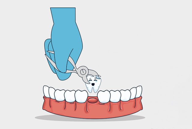 for-damaged-teeth-do-extractions-is-the-only-option